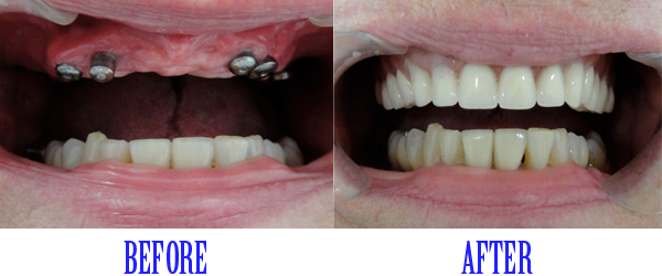 Full-Mouth-Rehabilitation-with-Dental-Implants-3