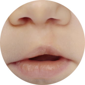 best cleft lip and palate surgery in india