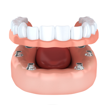 all on four implants of dental implants cost is affordable