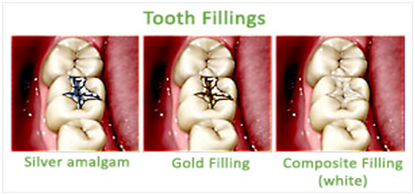 Tooth filling