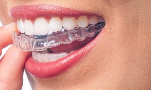 invisible braces at Aesthetica Dental Implant Clinic can change your life