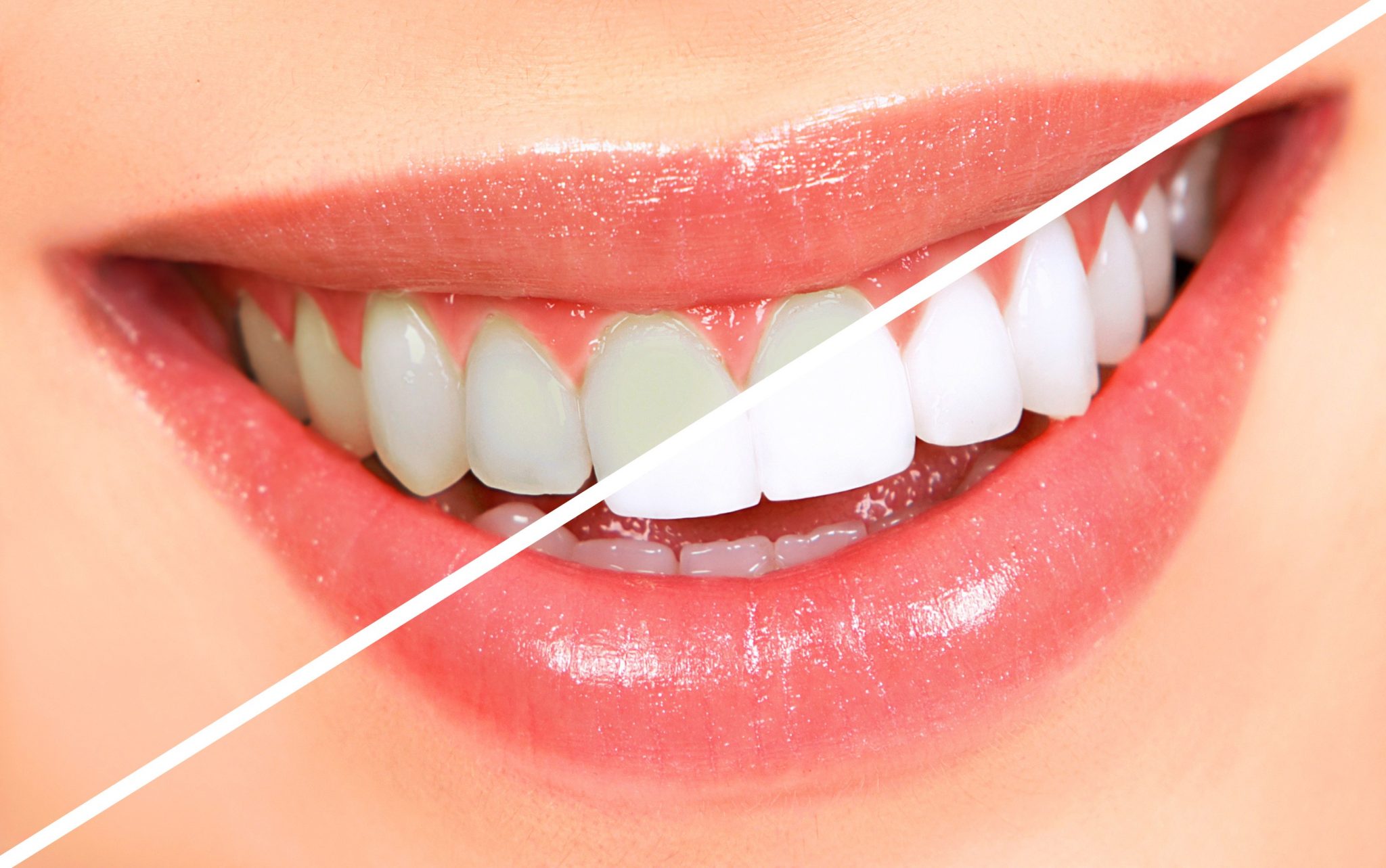 teeth-whitening at Aesthetica Dental Implant Clinic