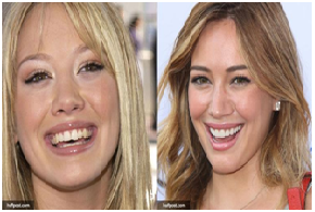 Celebrities Who opted for Cosmetic Dentistry