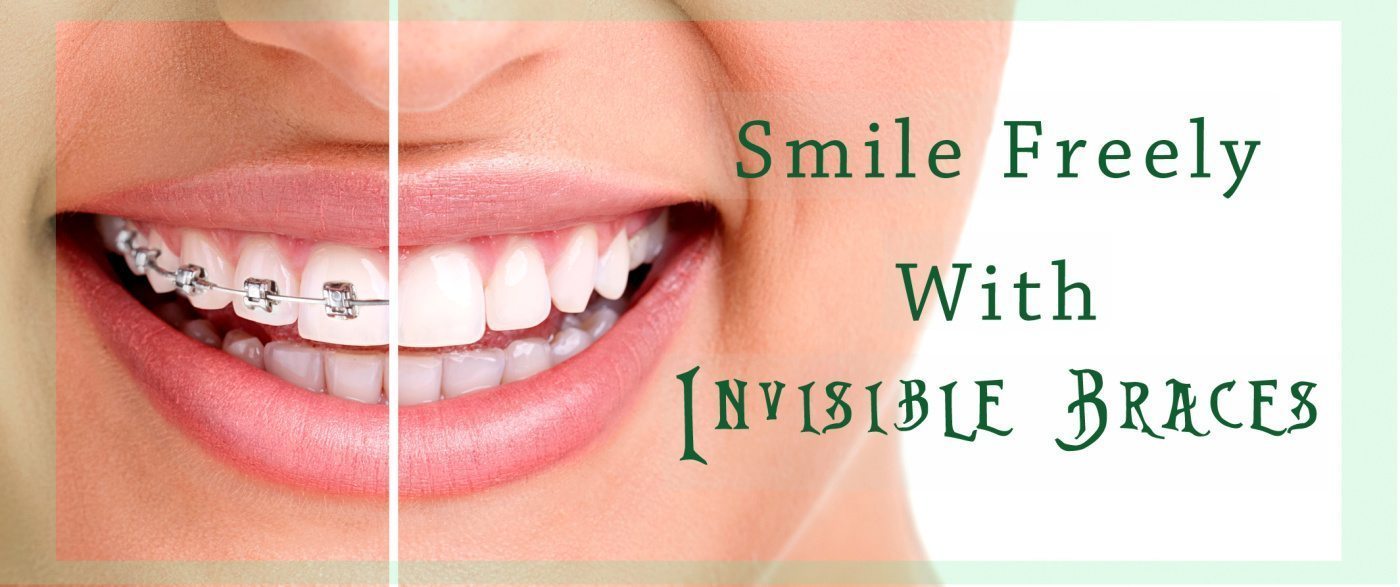 Demand for invisible braces has emerged greatly