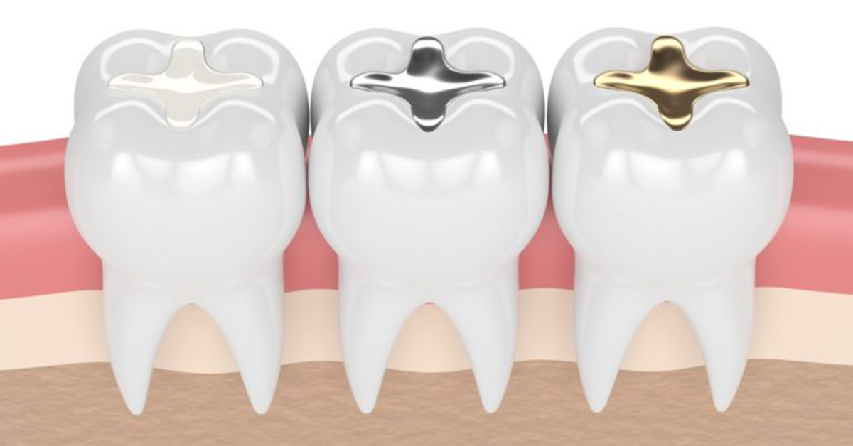 Cavity filling is necessary to prevent situations from getting worse