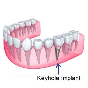 Keyhole implants better than Dental implants