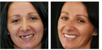 Reconstruct your Damaged teeth, bring life to them
