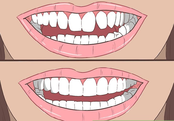 Teeth straightening