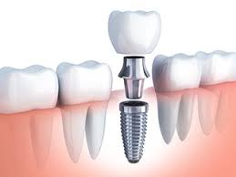 Some focus on the different parts of dental Implant