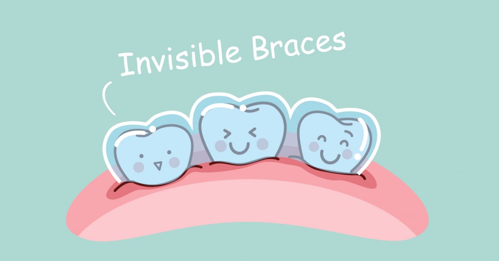 Do invisible braces work?