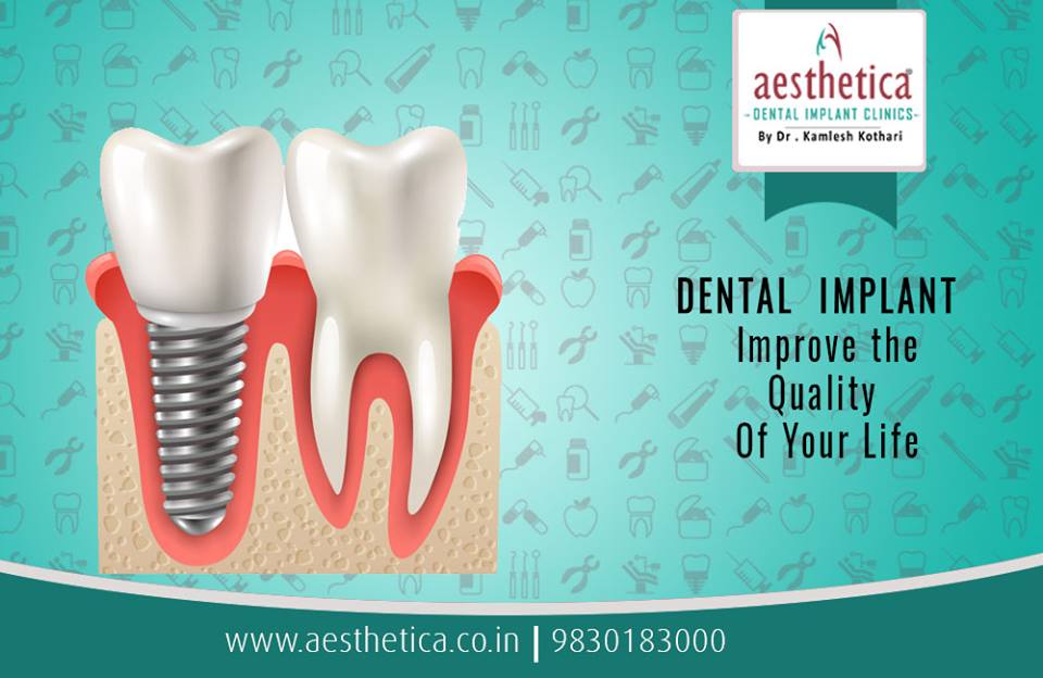 KNOW MORE ABOUT KEYHOLE IMPLANTS