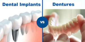 Dental Implant vs Dentures