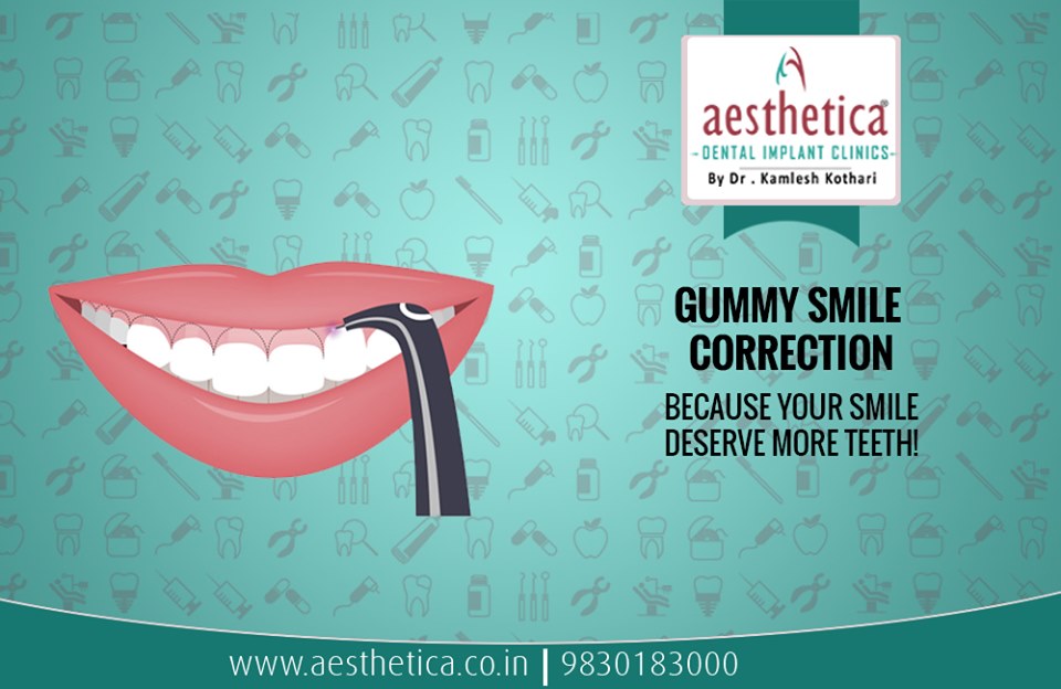 Gummy Smile Correction | Aesthetica