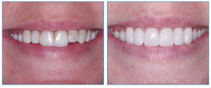 Teeth Straightening Surgery