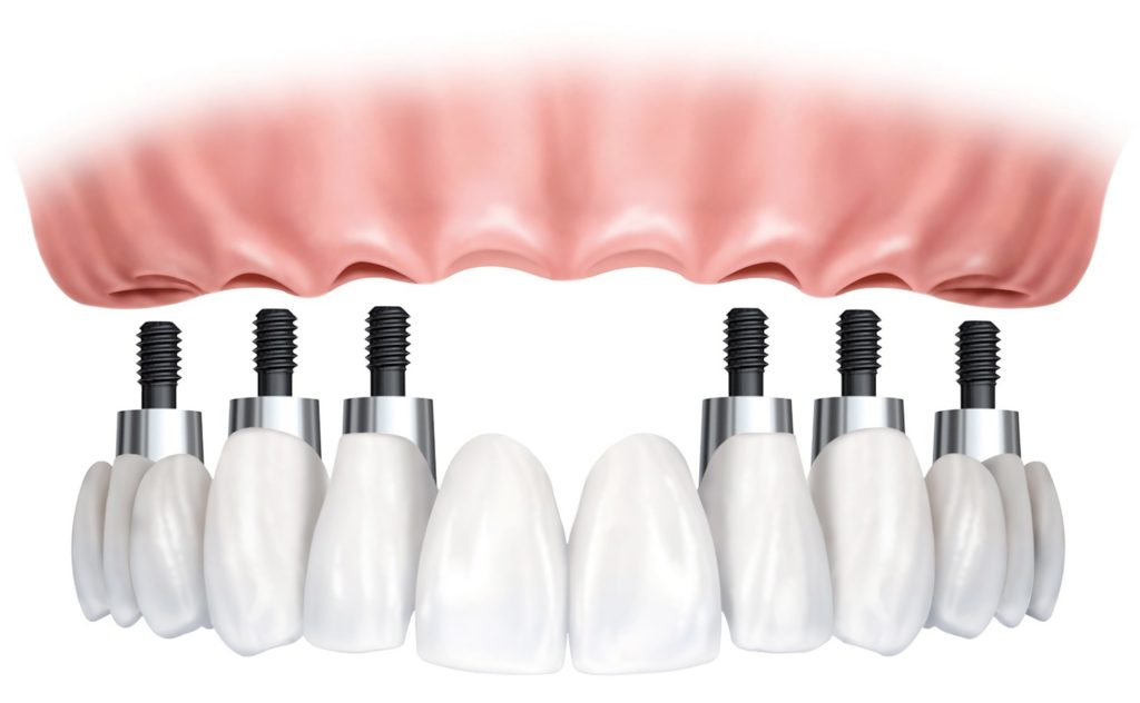 5 important aspects to know about bone grafting