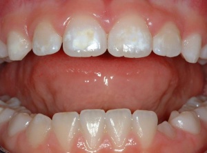 Improve your dental aesthetics with Enamel Microabrasion procedure
