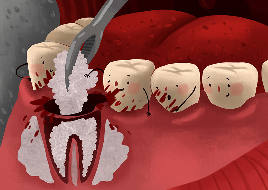 Advantages of Bone Grafting | Best Dental Implants Clinic in Howrah