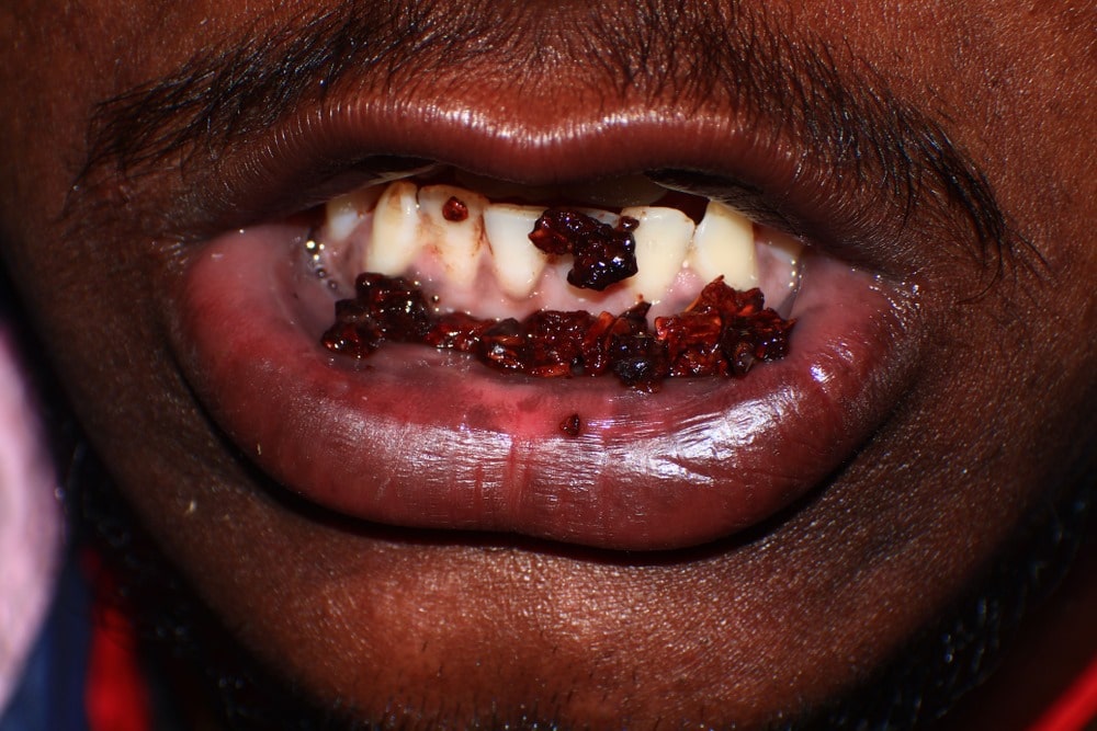 Effects of Chewing Tobacco on Oral Health