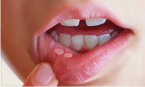 Facts About Mouth Ulcers