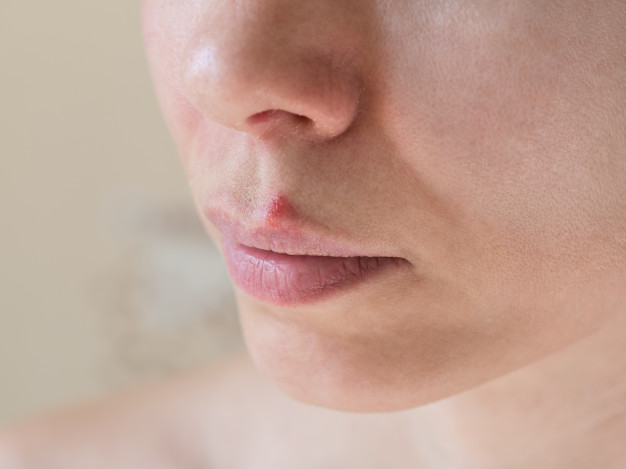 All about cold sores