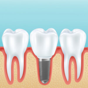 Lesser Known Facts About Dental Implants