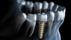dental implant kolkata