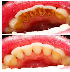 Teeth Cleaning (Scaling)