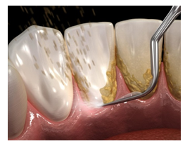 Teeth Cleaning (Scaling)