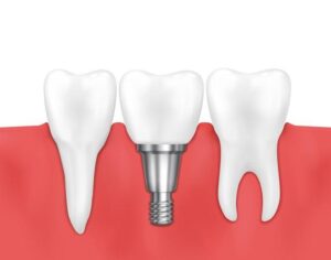what are the types of dental crowns