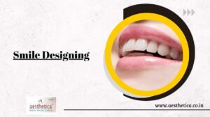 smile designing