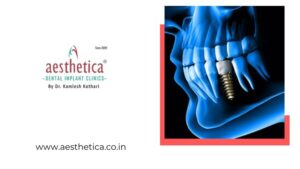 dental implant specialist in Kolkata