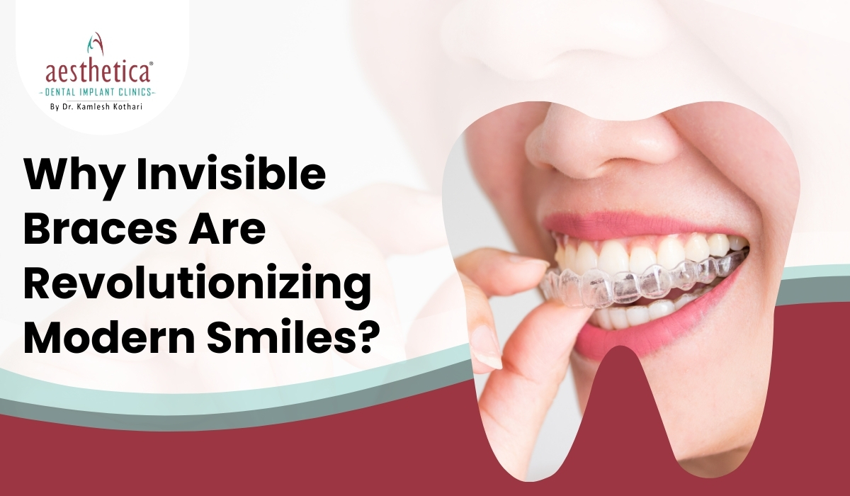 Close-up of clear aligners used as invisible braces